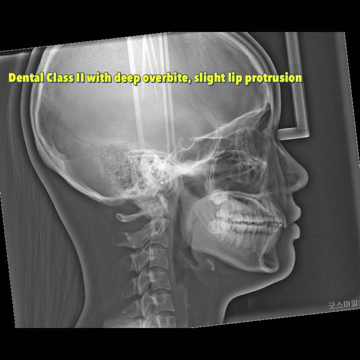 Treatment of dental Class I with deep overbite and…