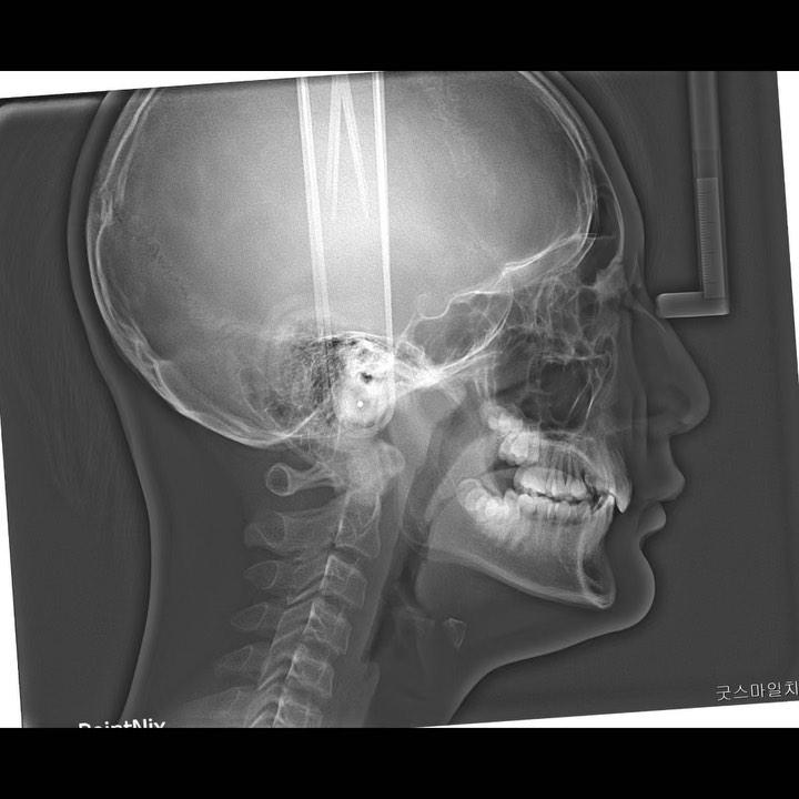 Treatment of skeletal Class II, dental Class II di…
