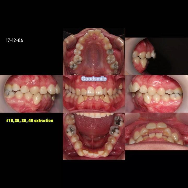 Treatment of skeletal Class II with severe lower a…
