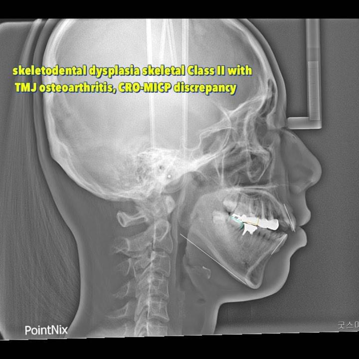Treatment of a patient with severe TMJ resorption,…