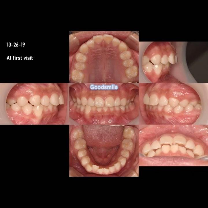 Correction of Class II with lower anterior crowdin…
