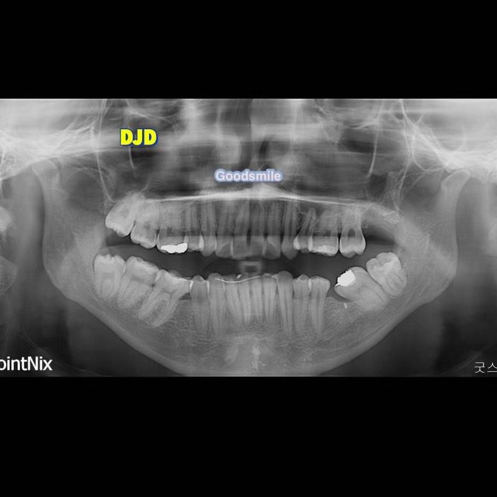 work in progress to treat skeletal Class II with s…