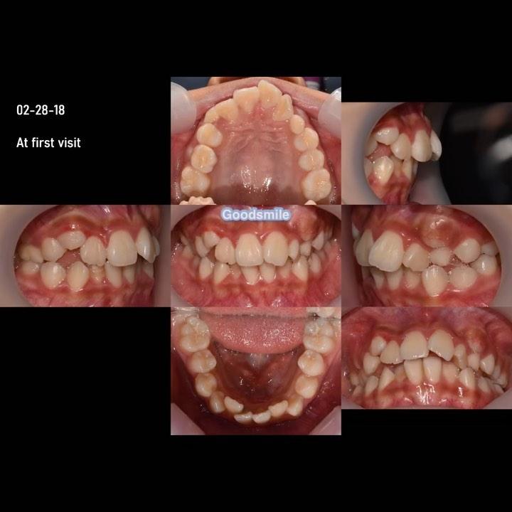 Treatment of skeletal Class III with mandibular ex…