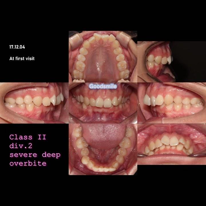 How to correct Class II, division 2 with severe de…