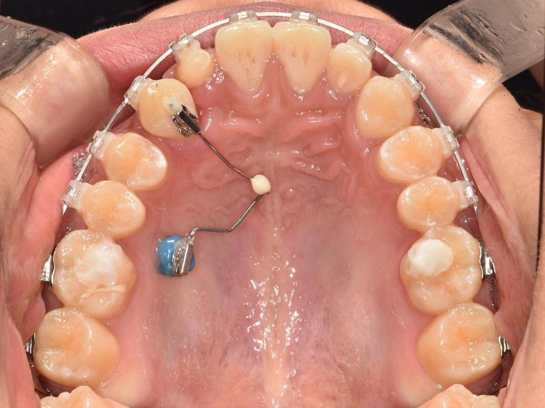 To correct inclination of impacted canine by using…