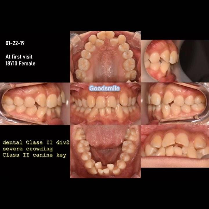 Treatment of skeletal Class III, dental Class II w…
