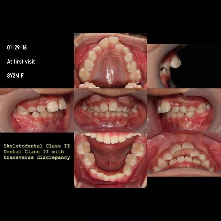 2-Phase treatment of skeletal Class II, dental Cla…