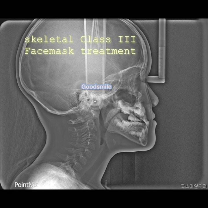 Phase one treatment of skeletal Class III, dental …
