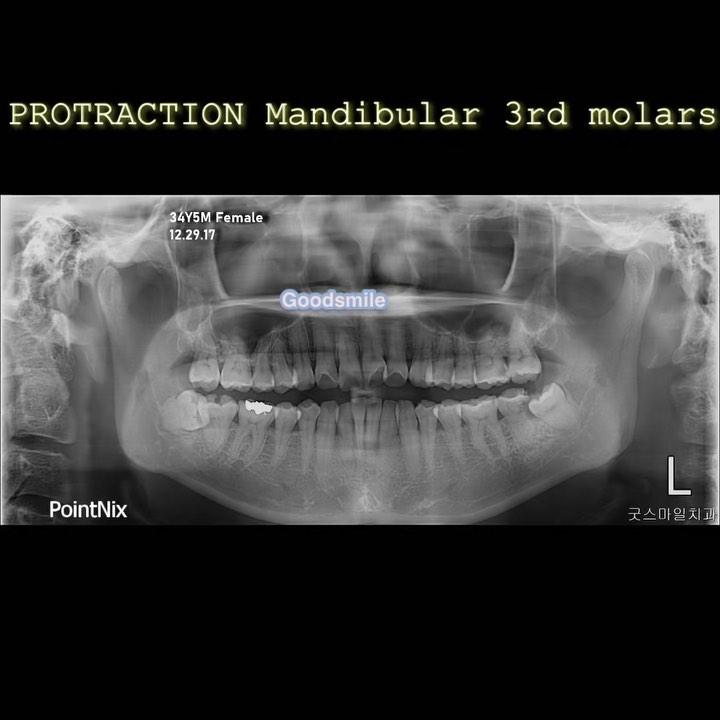 Challenging case
protraction of both impacted man…