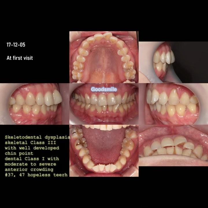 Protraction of both impacted mandibular 3rd molars…