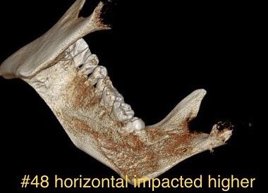 Aforementioned CBCT images of before and after
A…