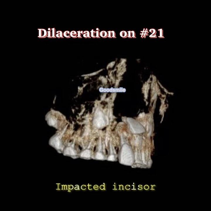 Orthodontic traction of impacted upper incisor wit…