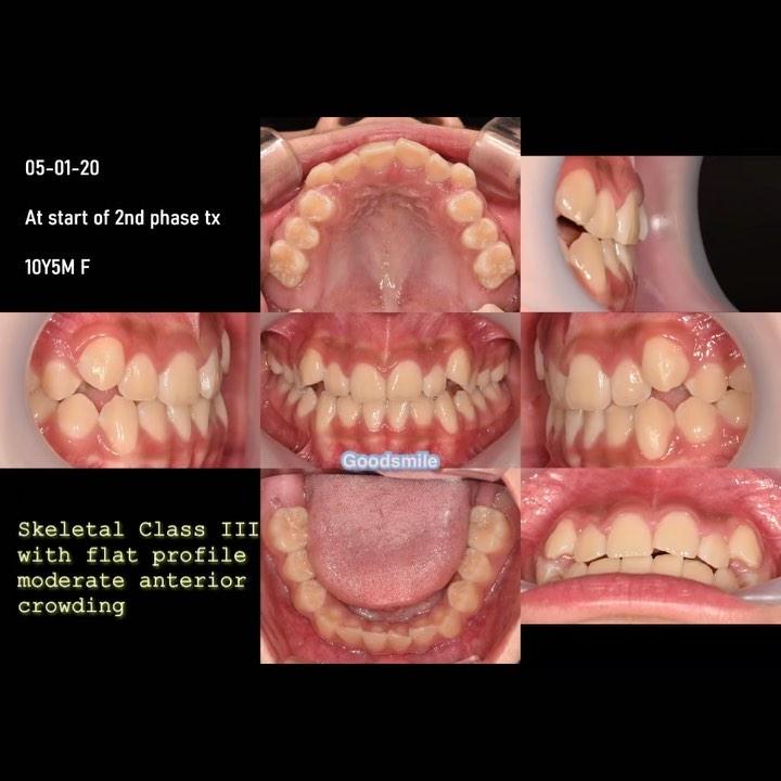 Treatment of skeletal Class III with anterior mode…