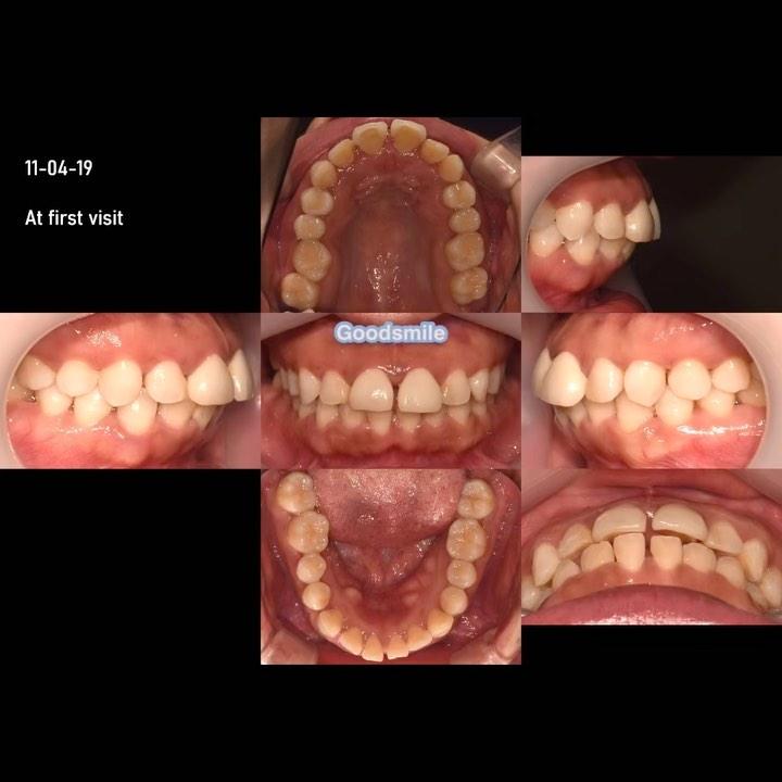 Treatment of dental Class I with lip protrusion an…