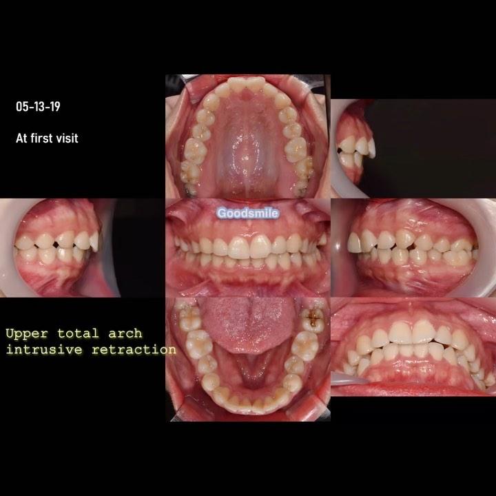 Treatment of skeletal Class I, dental Class II, di…