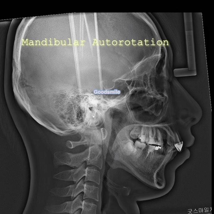 Mandibular autorotation in hyperdivergent patient …