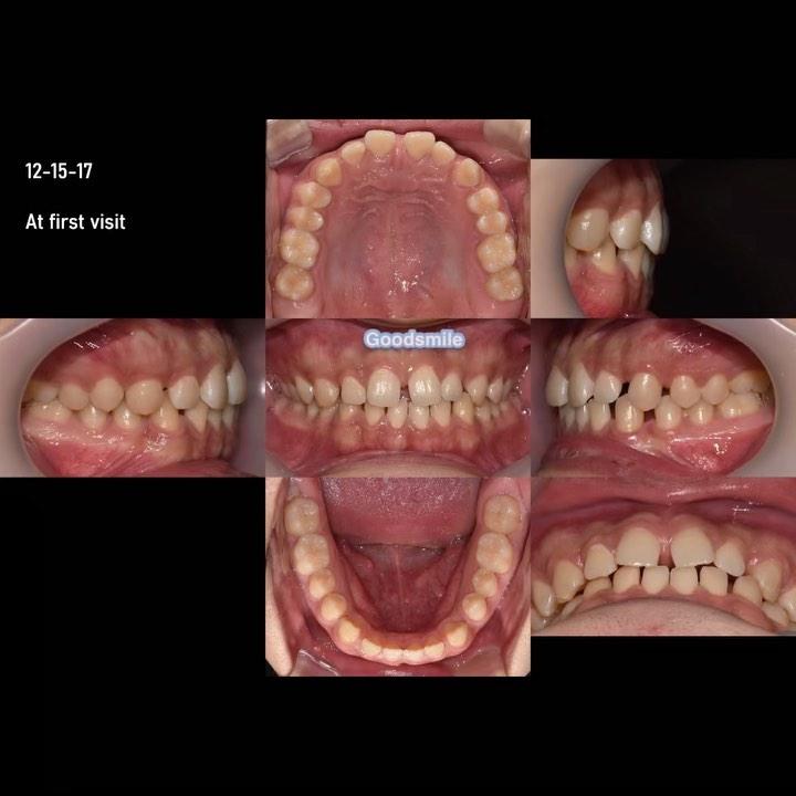 Space closure with maintaining inclination of ante…
