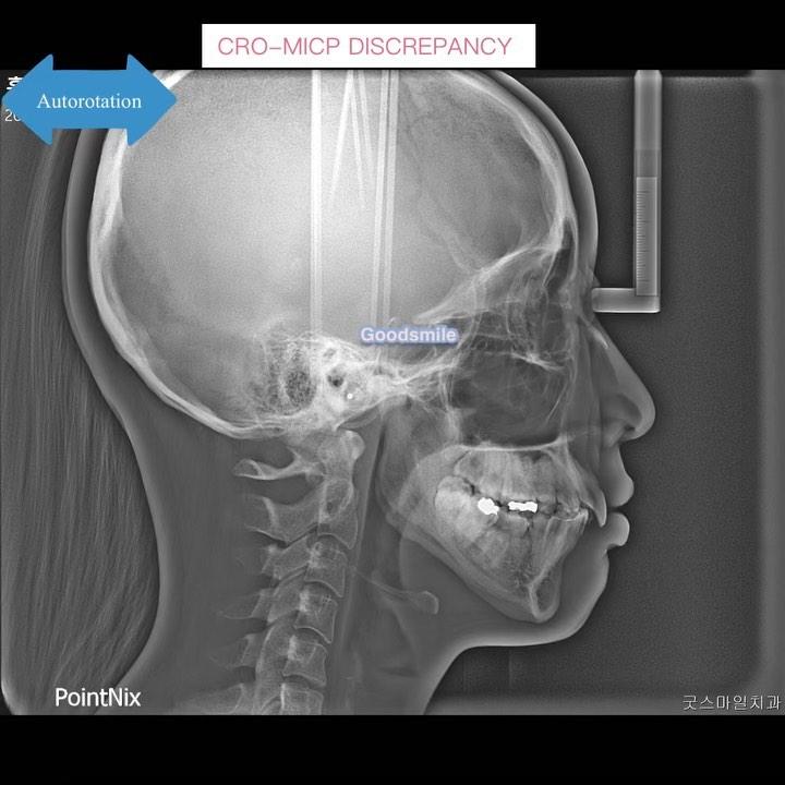 Mandibular autorotation after upper total arch int…