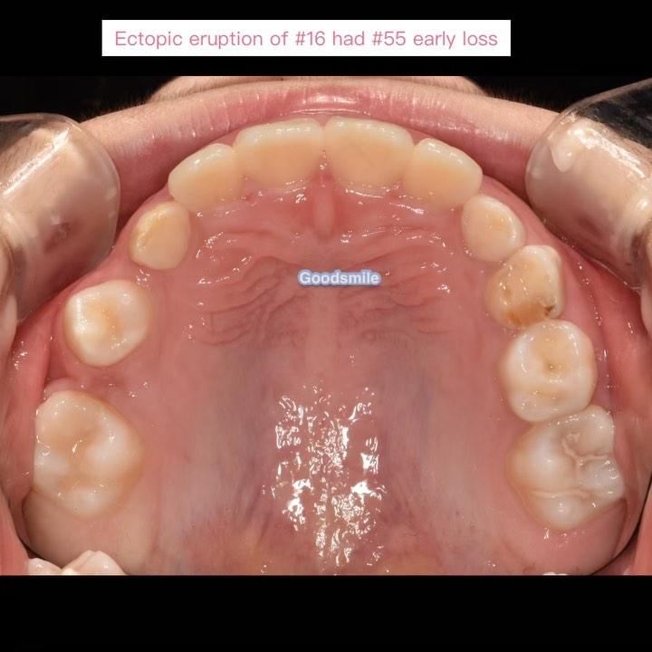 Space regaining of upper right 2nd premolar due to…