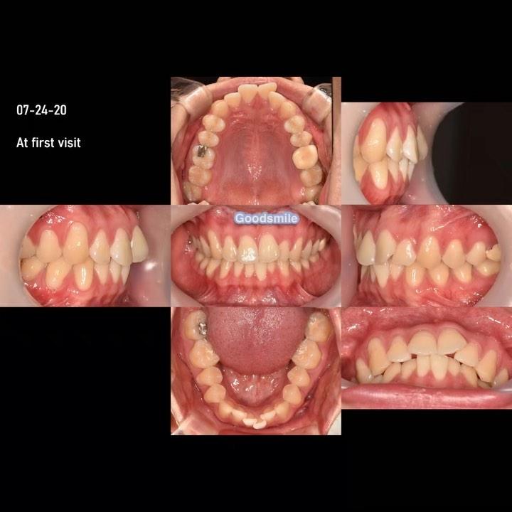 Nonextraction treatment of moderate anterior crowd…
