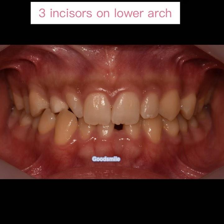 Treatment of palatal impacted #13 between #12 & #1…