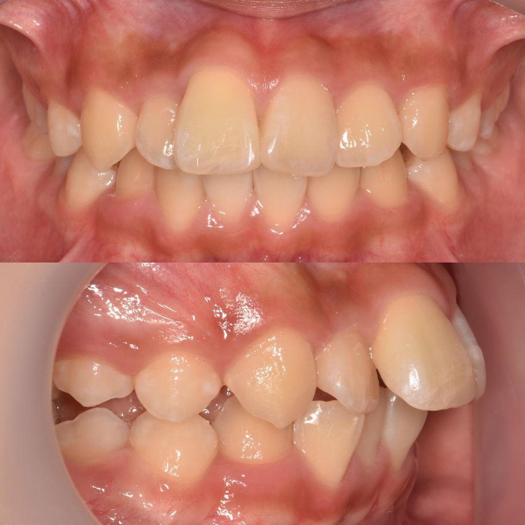 upper right central incisor was ankylosed due to a…