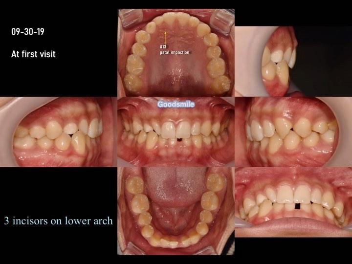 Treatment of severely horizontal impacted upper ca…