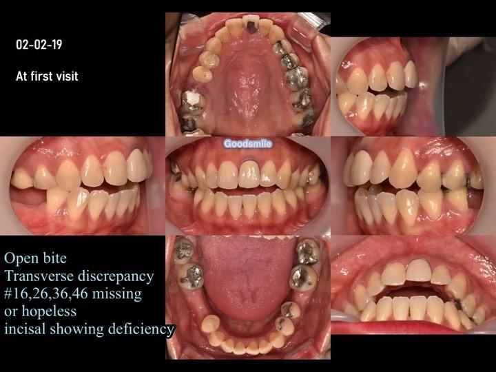 Treatment of skeletal Class I with transverse disc…
