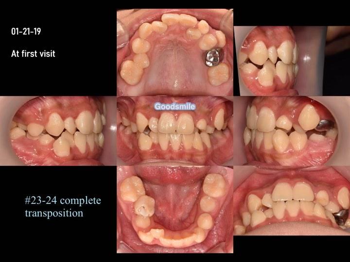Treatment of skeletal Class II with C-Pm1 complete…