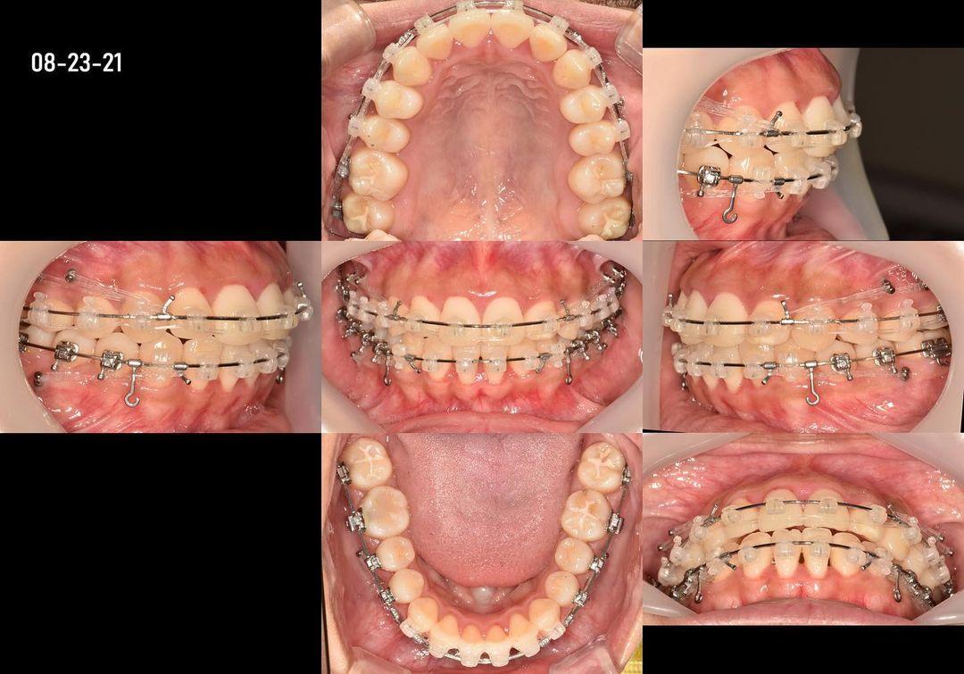 double arch retraction
4 microimplants on upper …