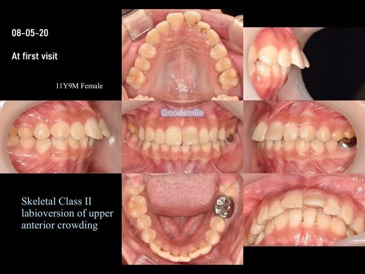 Treatment of skeletodental Class II, dental Class …