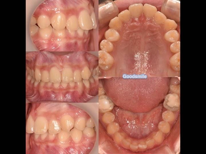 Treatment of dental Class II with prominent chin p…