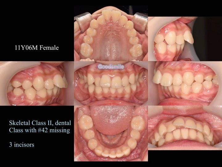 Treatment of dental Class II with lower 3 incisors…
