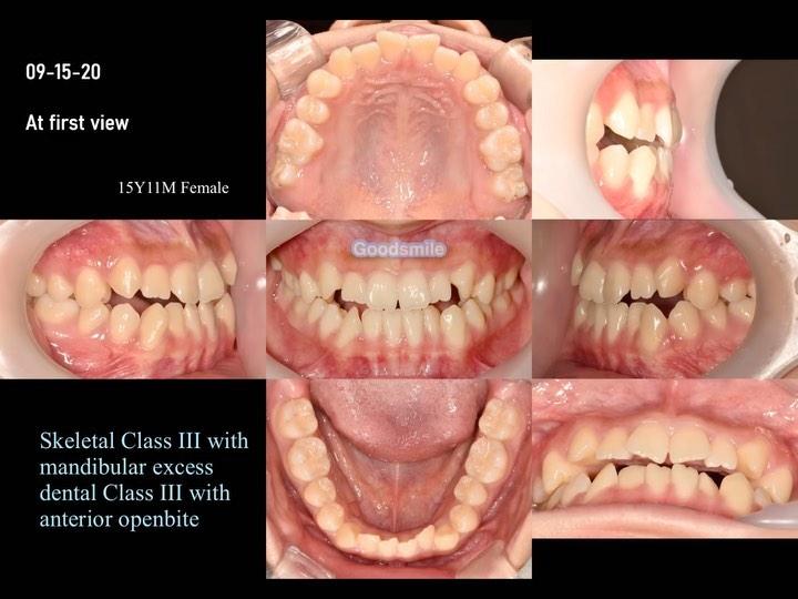 Treatment of skeletal Class III with mandibular ex…