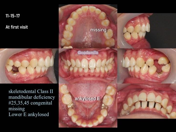 Treatment of skeletal Class II with mandibular def…