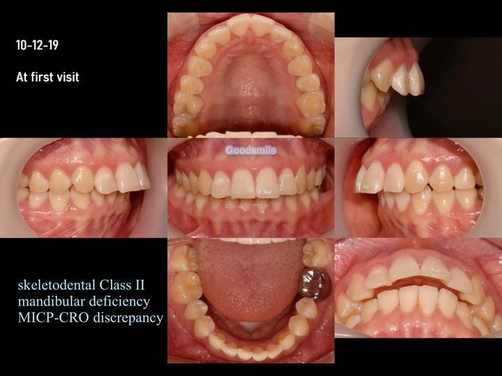 Treatment of skeletodental Class II with mandibula…