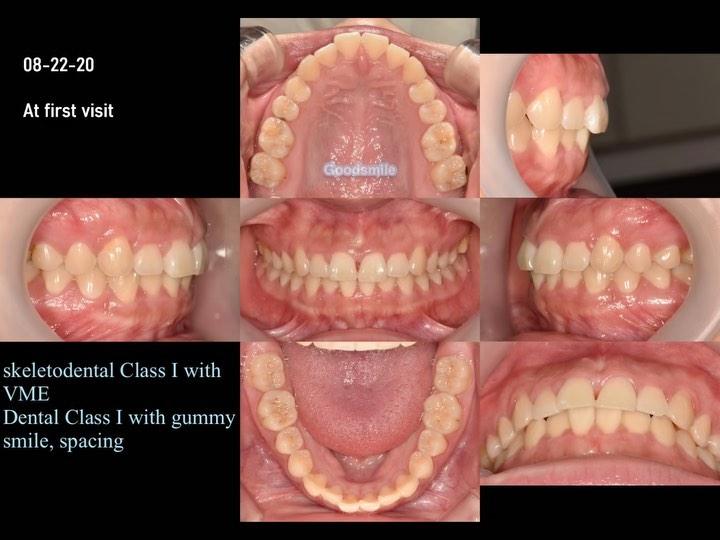 Treatment of skeletodental Class I with gummy smi…