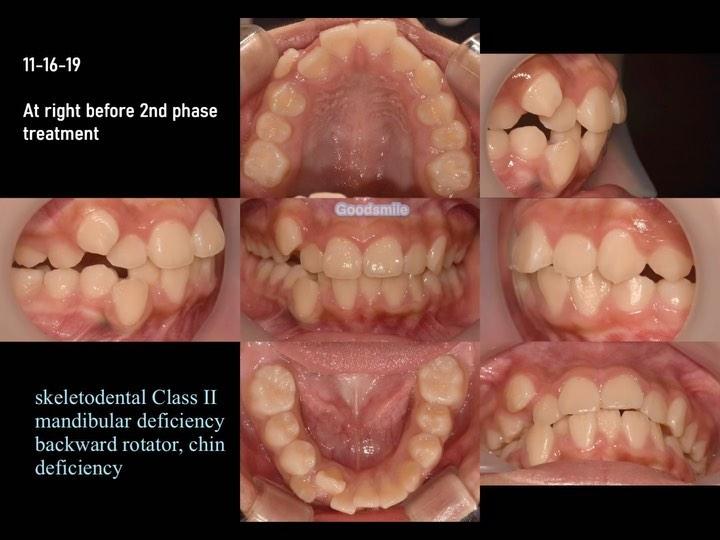 Is it good results? or not?
she presented gummy s…