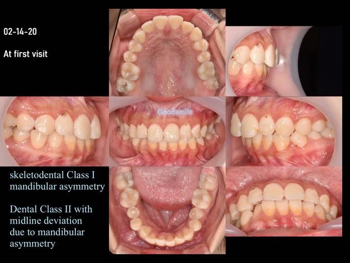 Treatment of skeletal Class I with mandibular asym…