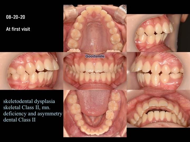 Treatment of dental Class II with congenital upper…