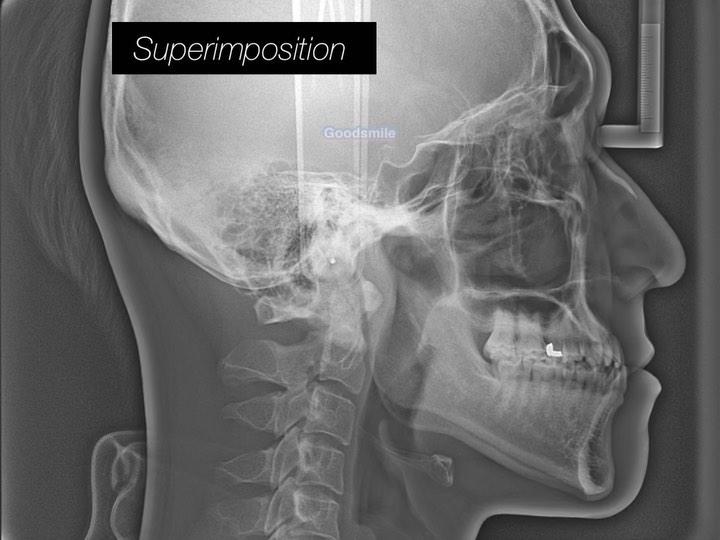 Treatment of skeletal Class III with mandibular ex…