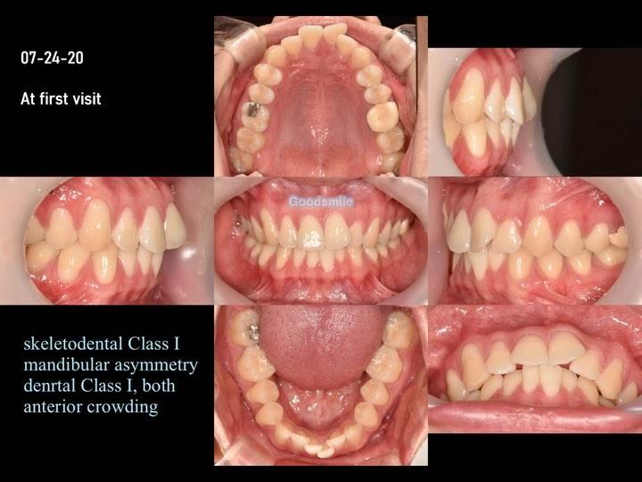 Camouflage treatment of skeletal Class I, dental C…