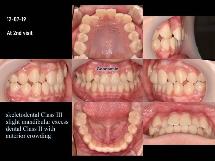 Camouflage treatment of skeletal Class III, dental…