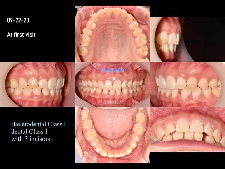 Treatment of dental Class I with 3 incisors
#bla…