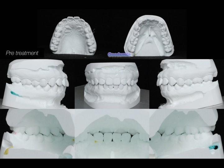 Total arch retraction
#blackshaqgoodsmile #굿스마일치…