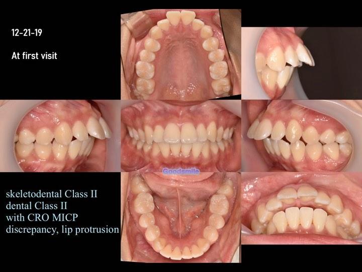 Treatment of skeletal Class II, dental Class II wi…