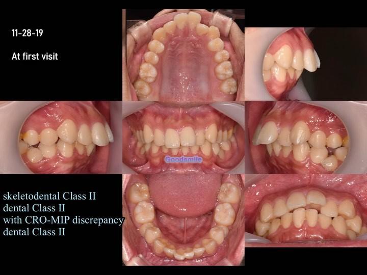Treatment of skeletal Class II with lipprotrusion …