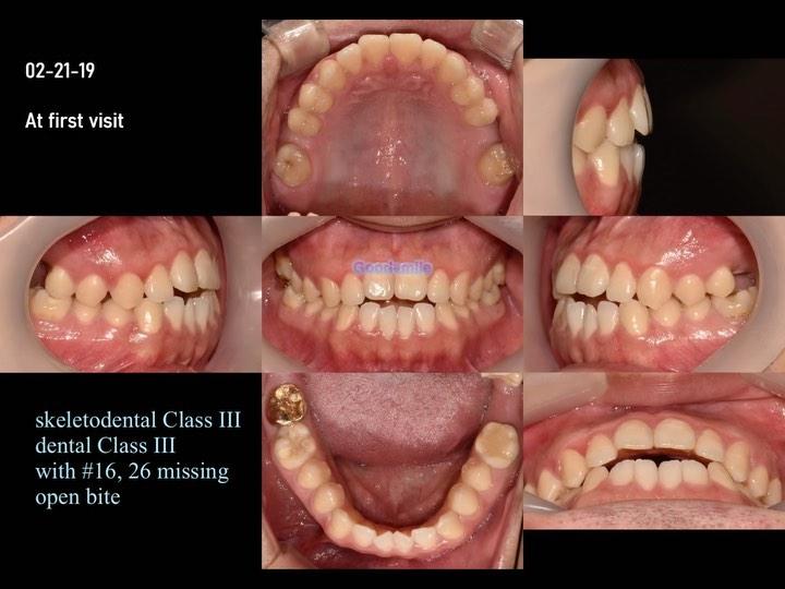 Treatment of skeletal Class III, dental Class III …