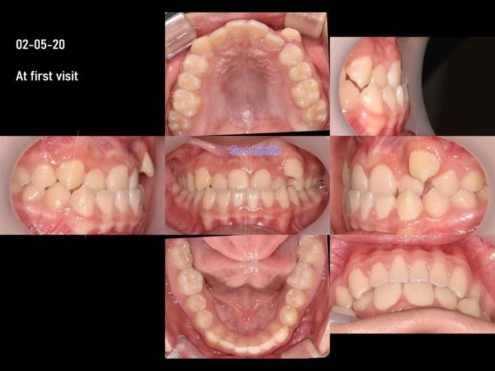 Treatment of skeletal Class III with MARPE with f…