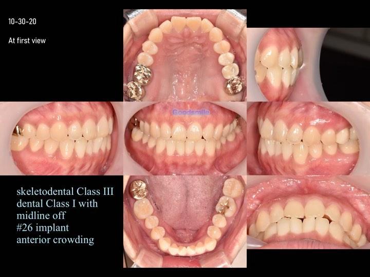 Treatment of skeletal Class I with mandibular asym…